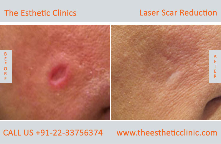 Laser scar reduction removal Treatment before after photos in mumbai india (3)